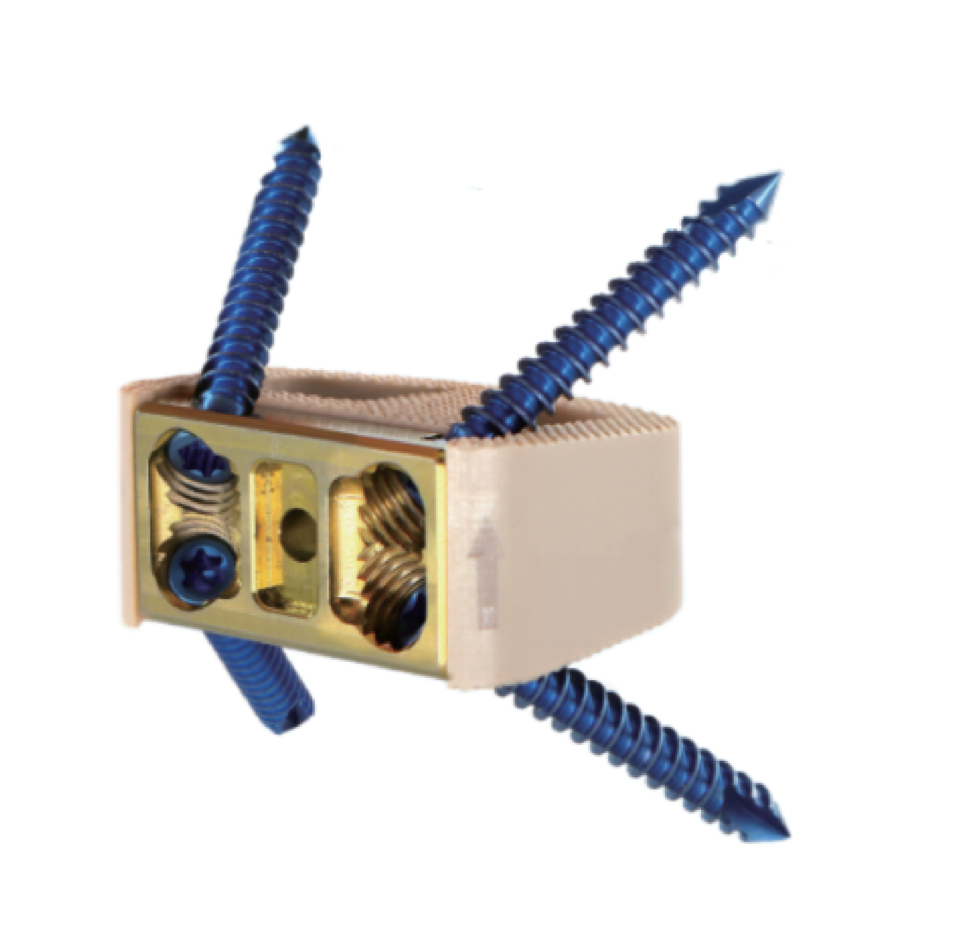 自穩定型椎間融合器